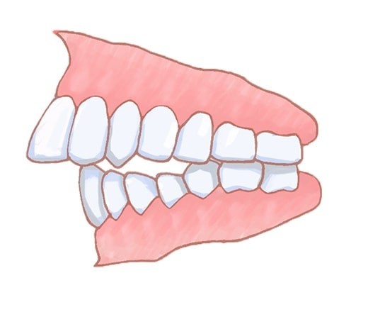 不正咬合の矯正治療 28] 外科矯正治療・反対咬合・開咬｜たまむら矯正歯科｜尼崎・伊丹の
